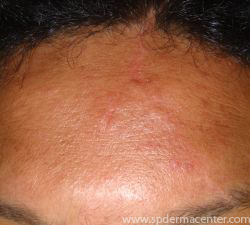 Acne Scar Co2 Fraxel After